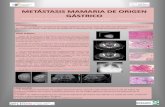 METÁSTASIS MAMARIA DE ORIGEN GÁSTRICO · Deben ser diferenciados de los cánceres lobulares de mama con células en anillo de sello, ... nódulo denso espiculado Imagen 2. Ovarios