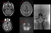 AYTAN KEKLİK - Neurovascular Exchange · dismetria, frust paresis in right arm and absence of GAG reflex on both sides were found on neurological examination. 3 leo stent. Increased