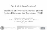 Treatment of severe adenomyosis prior to Assisted Reproductive Techniques …seud.org/wp-content/uploads/2016/05/Somigliana-Barcello... · 2016-05-23 · Tips & tricks in endometriosis