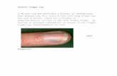 finger tip.docx  Web viewIn 1812, glomus tumors were first identified by Wood as a tumor of the subcutaneous