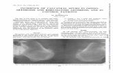 INCIDENCE OF CALCANEAL SPURS OSTEO- ARTHROSIS ... · aspect of the calcaneus at the epiphyseal line, coinciding with the insertion of the posterior fibres ofthe long plantar ligament.