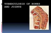 TUBERCULOSIS OF BONES AND JOINTS - generalsurgery.ucoz.ru file••tuberculous gonitis, or knee joint TB (15- 20%) General surgery department of SGMU Lecturer –ass. Khilgiyaev R.H.