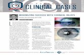 MAXIMIZING SUCCESS WITH CORNEAL INLAYS - millennialeye.com · 30 INSERT TO CATARACT & REFRACTIVE SURGERY TODAY| JANUARY 2018 SURGICAL TECHNIQUE A Staged Approach For surgeons new