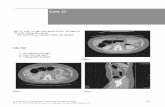 Case 21 - cdha.info · PDF fileGIST là một tập hợp con của các u trung mô dạ dày ruột, xuất phát từ lớp cơ của thành ruột. Tên gọi cũ là u cơ trơn