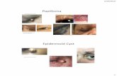Papilloma - American Optometric Association Meetings/2019...• 10060, incision and drainage of abscess (e.g., carbuncle, suppurative hidradenitis, cutaneous or subcutaneous abscess,