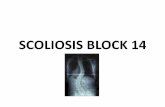 SCOLIOSIS BLOCK 14 - wickUPwickup.weebly.com/.../0/3/6/10368008/scoliosis_block_14.pdf · 2018-09-28 · SCOLIOSIS BLOCK 14 . Definition •Scoliosis is a fixed lateral curvature