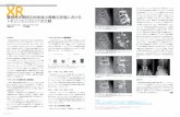 腰椎椎体間固定術術後の骨癒合評価における トモシ …/media/Downloads/JP/...3） James T Dobbins: Digital X-ray Tomosynthesis: Current state of the art and clinical
