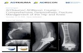 Event program AOTrauma | AORecon Course— Comprehensive Periprosthetic Fracture ... · 2018-11-06 · Fracture reduction and fixation to restore anatomical relationships. 1 4 2 3