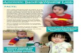 Amniotic Banding/Missing Limb - faithadopt.org · Amniotic Banding/Missing Limb 7 . Arthrogryposis FACTS: • Arthrogryposis is characterized by multiple frozen joints and is usually