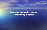 Transforaminal Lumbar Interbody Fusion WITH TLIF.pdf · done bilateral L4, L5 S1 roots decompressed. SPINE AP KIRAN BANSAL SUF 17217'NDWlSN INDIAN SPINAL INJURIES CENTRESEC-c, uasnNT