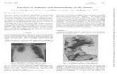 Exposure Asbestos and Mesothelioma of the PleuraMesothelioma-Fowler et al. soft and necrotic. Elsewhere growth bulged into the substance of the lung, but nowhere were there deep islands