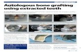 IMPLANT ESSENTIALS Autologous bone grafting using extraded ... · In practice, the graft does not crumble and exhibits a capadty to bond. A membrane and sutures do not seem to be