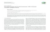 Case Report Parapharyngeal Neck Schwannomas with …downloads.hindawi.com/journals/crim/2013/563019.pdfParapharyngeal Neck Schwannomas with Unusual Vascular Displacement KiranSargar