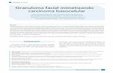 Granuloma facial mimetizando carcinoma basocelulardocs.bvsalud.org/biblioref/2017/08/847992/rdt_v22n3_107-110.pdf · cas, como carcinoma basocelular. Descrição do caso: Mulher,