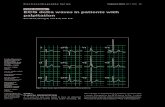 CME Article ECG delta waves in patients with palpitation · 2011-02-24 · palpitation Soo W M, Chong E, Teo S G, Poh K K CASE 1 CLINICAL PRESENTATION A 37-year-old man was found