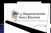 PRP y Regeneración Ósea Maxilarde seno bilateral (Bio-Oss VS hueso bovino desmineralización + PRP). En las muestras no observaron diferencias significativas. Wiltfang, efectuó