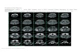 Supplemental Figures - Nature Research · Supplemental Figures . Supplemental Figure 1. Axial MRI Images from ZIKV Infected Pigtail Macaque 43 Days After a Inoculation . Serial axial
