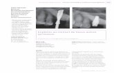 Implants au contact de tissus autres qu’osseux....Szmukler-Moncler 2009a), de dents ankylosées (Davarpanah & Szmukler-Moncler 2009b) ou de racines résiduelles (Szmukler- Moncler