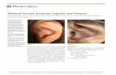Bilateral Pruritic Auricular Papules and Plaques · September 15, 2016 Poto Quiz A 59-year-old woman presented with several years of persistent and worsening bilateral pruritic auricular