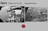 Quiz femme de 21 ans asymptomatiqueonclepaul.net/wp-content/uploads/2011/07/QUIZ-GILLES-G-04-B-rate.… · •bicytopénie fébrile (faisant discuter une nécrose médullaire) •la
