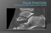 Classificationao-danmark.dk/.../02/6-TalusCalcAONordic2018CPH.pdf · Classification – talar neck fracture Hawkins*--Prognostic Based on Blood Flow Type I non displaced fractures