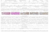 LE MYOFIBROBLASTOME MAMMAIRE. A PROPOS D’UNsenologie.tv/pdf/posters/5892f7276a438.pdf · > Biopsie: tumeur à cellules fusiformes disposées en faisceaux entrecroisés, associées