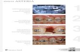 Asteria Graiff ita - Tokuyama€¦ · terapia(endo-orto-implanto-protesica). Figura 1 Fase ortodontica di riallineamento del gruppo frontale superiore. Figura 2 Plastica gengivale