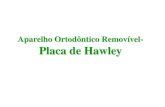 Aparelho Ortodôntico Removível- Placa de Hawleymoroortodontia.com.br/ortodontia/placahawley.pdf · 2020. 3. 31. · Hawley introduziu o aparelho palatal removível, no início do