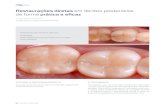 Restaurações diretas em dentes posteriores de forma prática ...A resina Opus Bulk Fill da FGM atende a qualquer clínica que utilize restaurações diretas em resina, permitindo