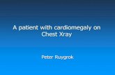 A patient with cardiomegaly on Chest Xray