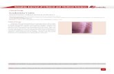 Clinical Image Leukemia Cutis · 2020. 9. 28. · Nissrine A, Gallouj S, Meziane M, Mernissi F (2015) Leukemia Cutis. Imaging J Clin Med Sciences 2(1): 010. DOI: 10.17352/2455-8702.000020.