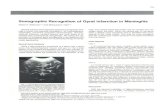 Sonographic Recognition of Gyral Infarction in Sonographic Recognition of Gyral Infarction in Meningitis
