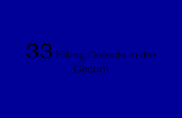 33 filling defects in the cecum