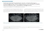 Intracranial isolated varix mimicking a meningioma: the ... Intracranial isolated varix mimicking a