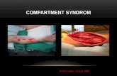 Compartment  syndrom