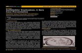 Gallbladder Duplication: A Rare Case Presentation gallbladder diverticulum, folded gallbladder, Phrygian