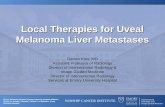 Local Therapies for Uveal Melanoma Liver Metastases