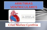 Arritmias ventriculares
