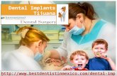 Dental implants in Mexico,Cancun & Tijuana from best dentists